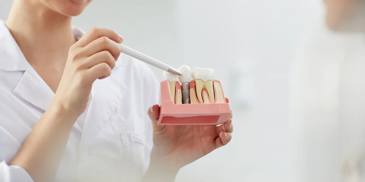 Dental Implants for Full Mouth