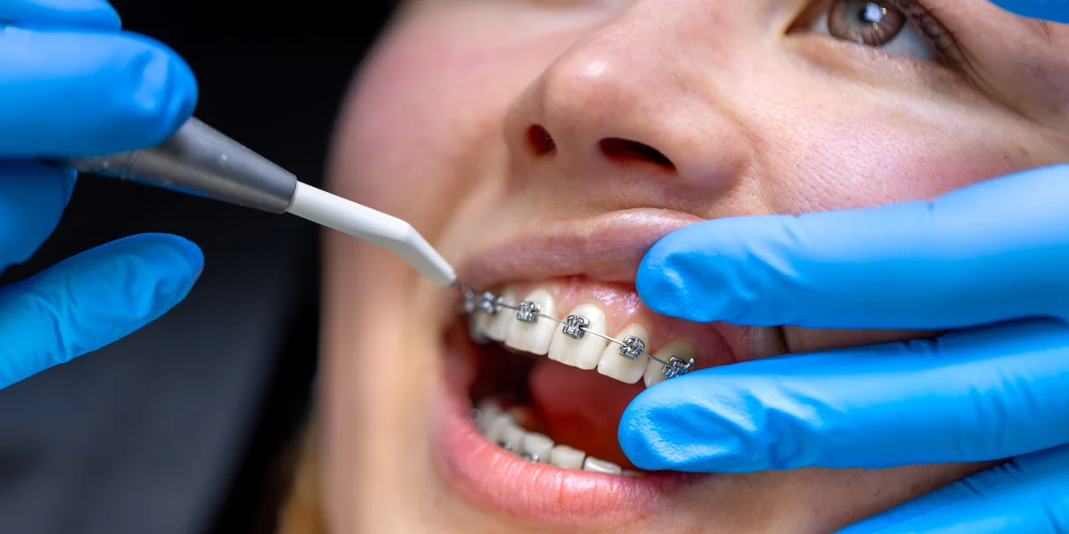 Orthodontic Treatment