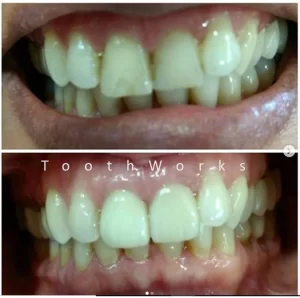 Smile Makeover 18