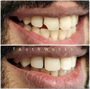 Smile Makeover 4