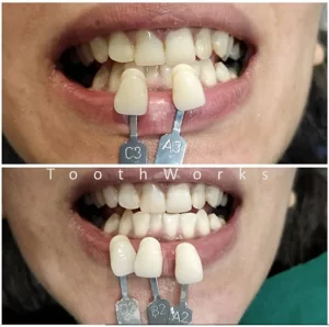 Smile Makeover 3