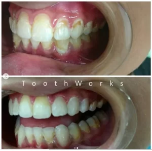 Smile Makeover 20