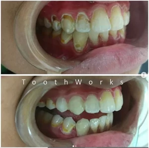 Smile Makeover 19