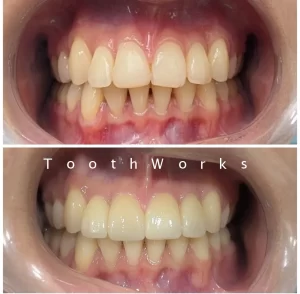 Smile Makeover 17