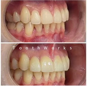 Smile Makeover 16