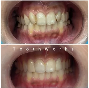 Smile Makeover 15