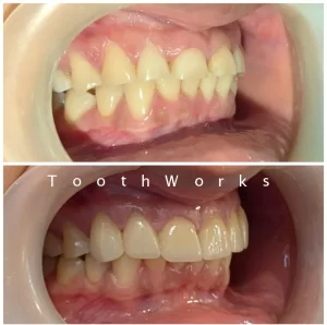 Smile Makeover 14