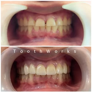 Smile Makeover 12