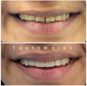 Smile Makeover 11