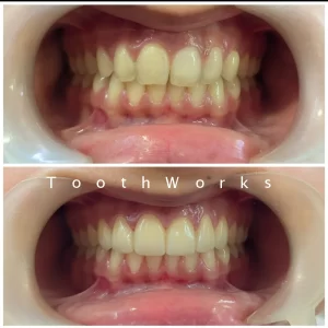 Smile Makeover 10