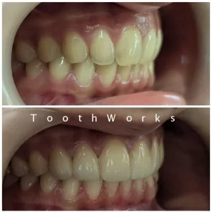Smile Makeover 9