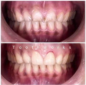Smile Makeover 8