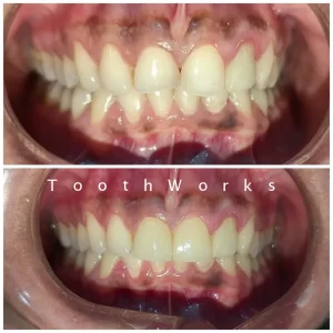 Smile Makeover 7
