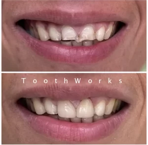 Smile Makeover 6