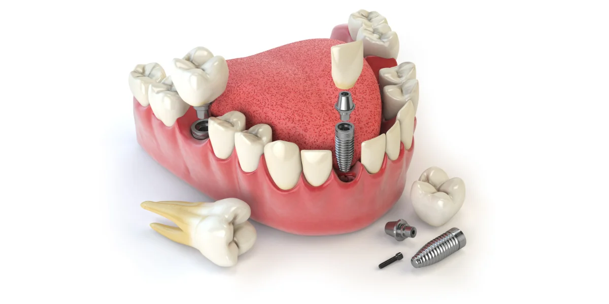 Full Dental Implants