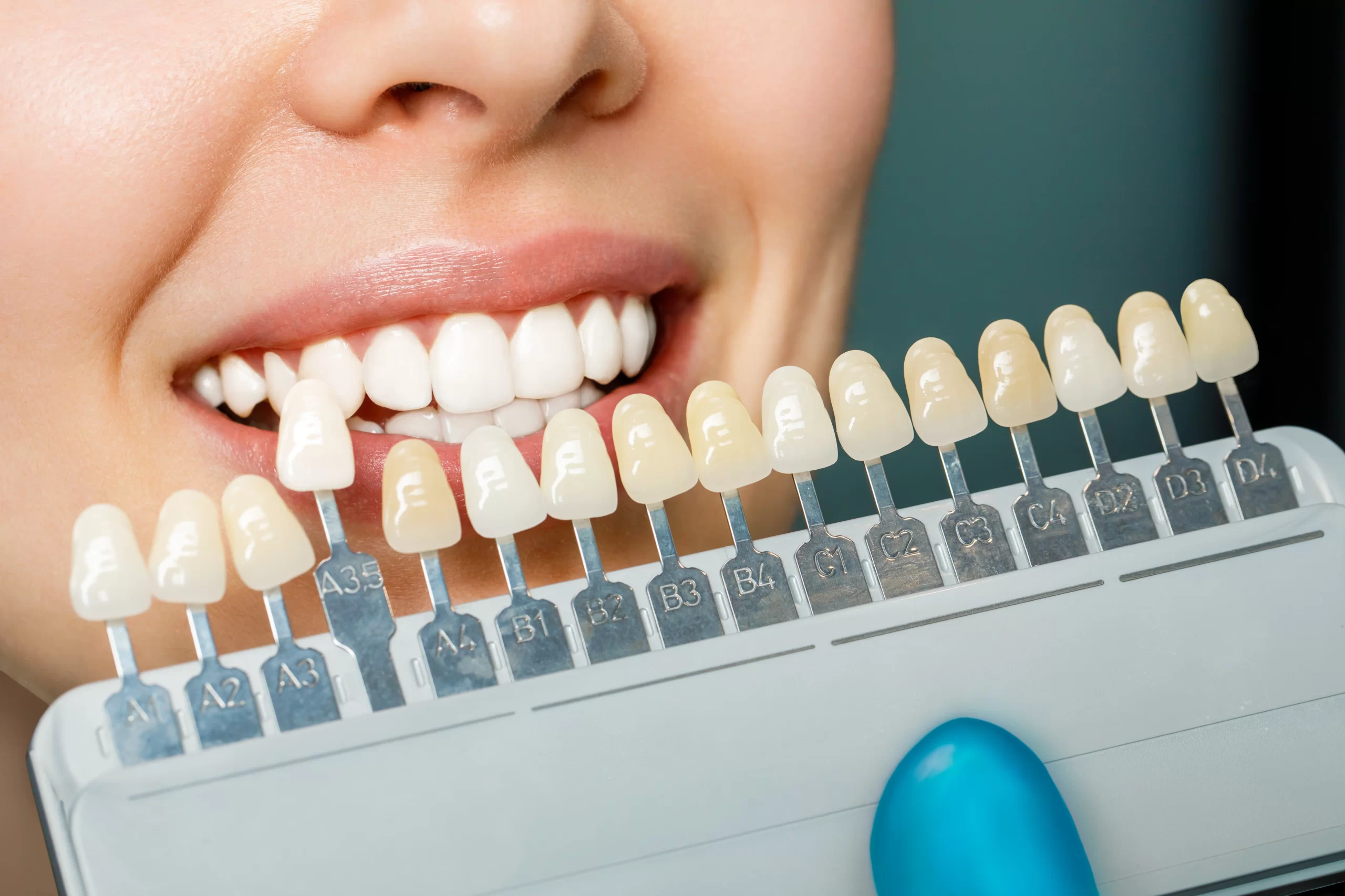 Smile Makeover in Mumbai