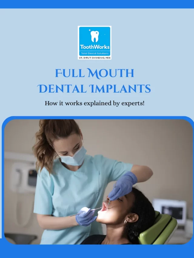 Full Mouth Dental Implant
