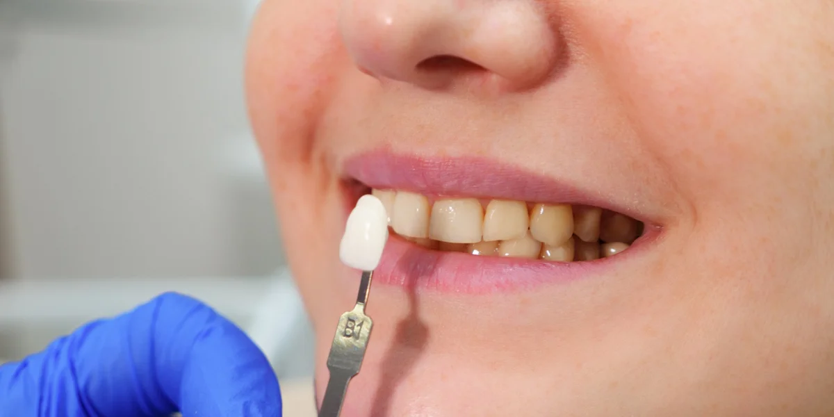 Veneer Checkup