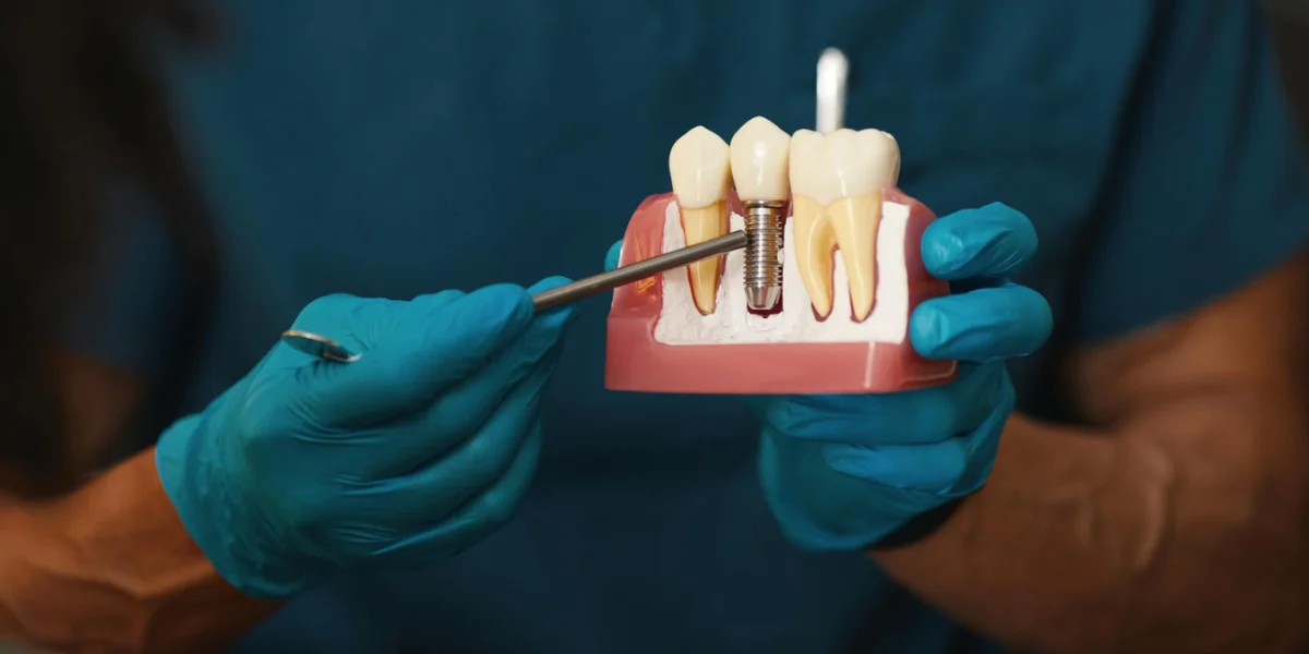 Post Dental Implants